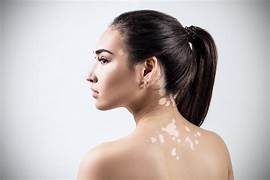 Vitiligo treatment